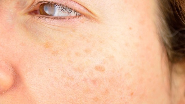 bai-viet/melanin-la-gi-tac-dong-cua-melanin-doi-voi-da-the-nao-52346.html