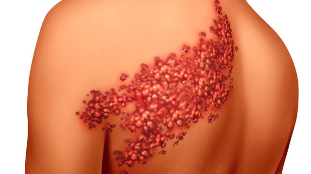 bai-viet/meo-chua-zona-than-kinh-tai-nha-don-gian-de-ap-dung.html