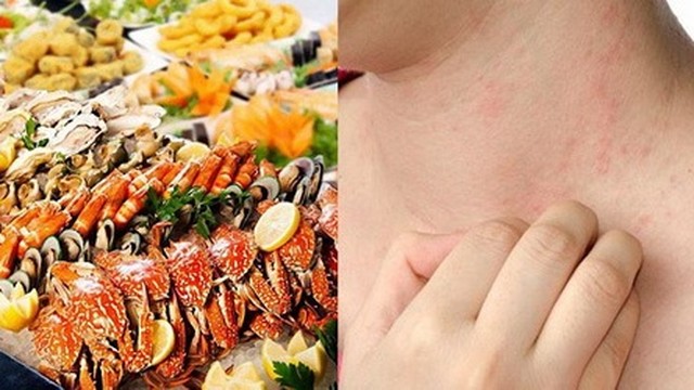 bai-viet/meo-tri-di-ung-hai-san-ban-can-biet-61074.html