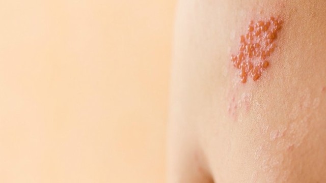 bai-viet/meo-tri-gioi-leo-bang-la-chuoi-co-hieu-qua-khong.html