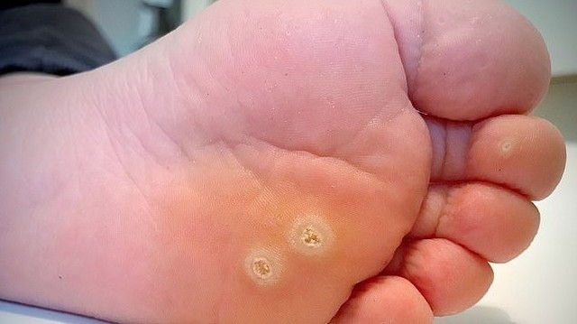 bai-viet/meo-tri-mun-coc-bang-voi-an-trau-don-gian-va-hieu-qua.html