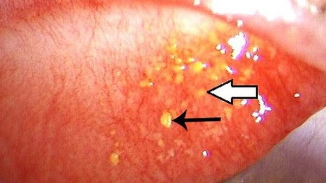 bai-viet/mi-mat-tren-noi-mun-trang-nho-co-sao-khong-62635.html