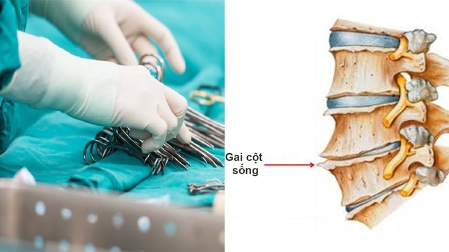 bai-viet/mo-gai-cot-song-het-bao-nhieu-tien-chi-phi-mo-doi-voi-tung-phuong-phap.html