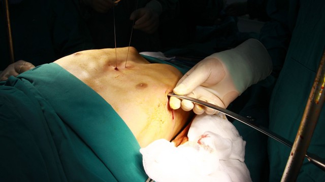 bai-viet/phuong-phap-mo-lom-nguc-o-nguoi-lon-60388.html