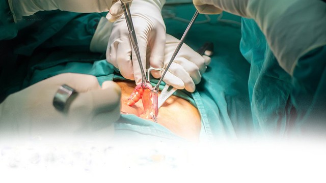 bai-viet/mo-ruot-thua-xong-co-beo-khong-cach-han-che-tinh-trang-len-can-sau-khi-mo.html