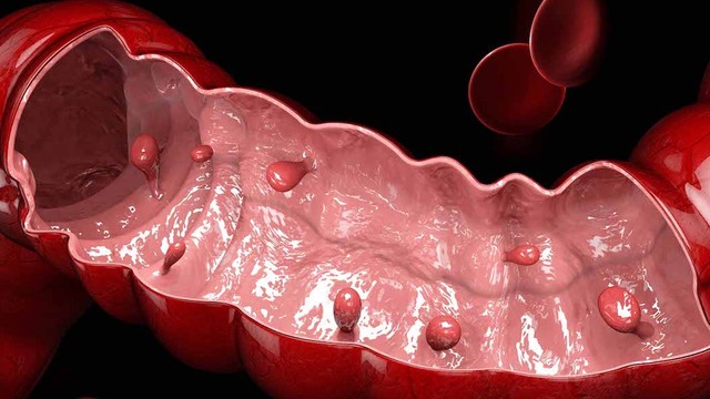 bai-viet/moi-lien-quan-giua-polyp-va-ung-thu-dai-truc-trang.html