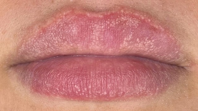 bai-viet/moi-noi-hat-san-sui-la-dau-hieu-cua-benh-gi.html