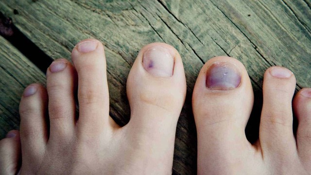 bai-viet/mong-chan-bi-den-bi-benh-gi-68012.html