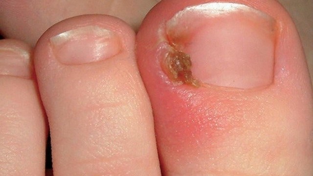 bai-viet/mong-chan-moc-nguoc-nguyen-nhan-trieu-chung-va-cach-xu-ly.html