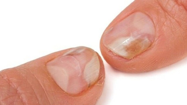 bai-viet/mong-tay-bi-hu-va-cach-xu-ly-an-toan-hieu-qua.html