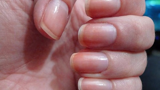 bai-viet/mong-tay-cua-nguoi-bi-benh-tim-co-gi-bat-thuong-nhan-biet-benh-tim-mach-tu-mong-tay.html