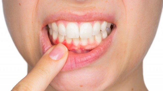 bai-viet/mot-so-cach-dieu-tri-viem-mo-te-bao-rang-57681.html