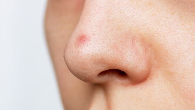 bai-viet/mot-so-cach-tri-mun-boc-o-mui-hieu-qua-nhanh-chong.html