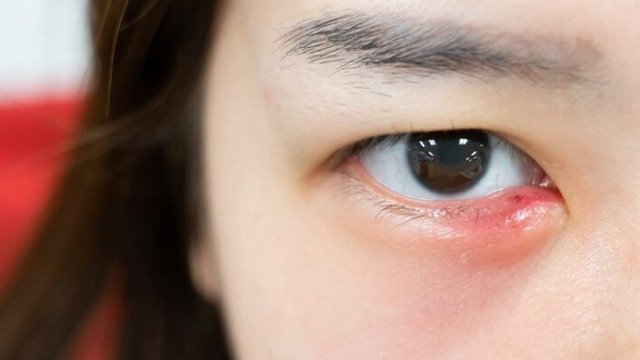 bai-viet/dau-hieu-bi-leo-mat-nhan-biet-som-de-dieu-tri-kip-thoi.html