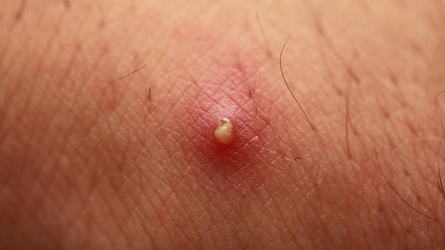 bai-viet/mu-la-gi-nguyen-nhan-va-trieu-chung-cua-tinh-trang-mung-mu.html