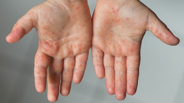 bai-viet/mua-tay-chan-mieng-cao-diem-la-khi-nao-can-lam-gi-de-phong-benh.html