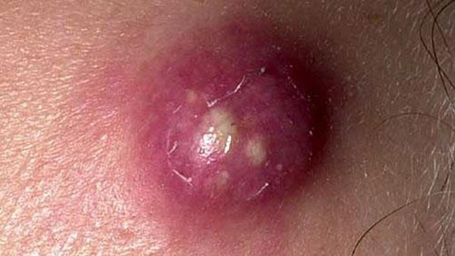 bai-viet/mun-ap-xe-la-gi-nguyen-nhan-va-cach-dieu-tri-hieu-qua.html