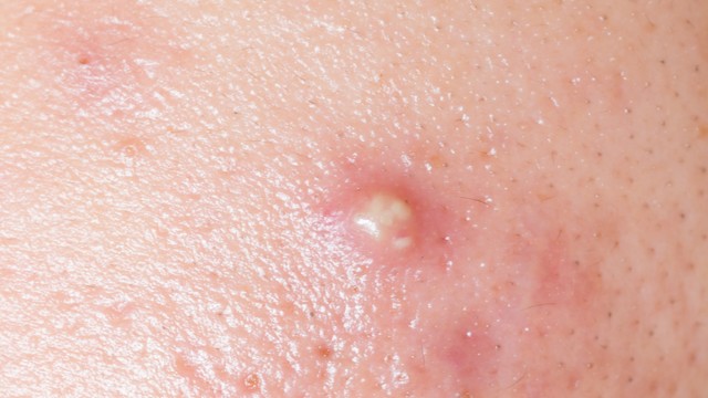 bai-viet/mun-boc-bao-lau-thi-chin-cach-nhan-biet-va-xu-ly-dung-thoi-diem-de-tranh-de-lai-seo.html