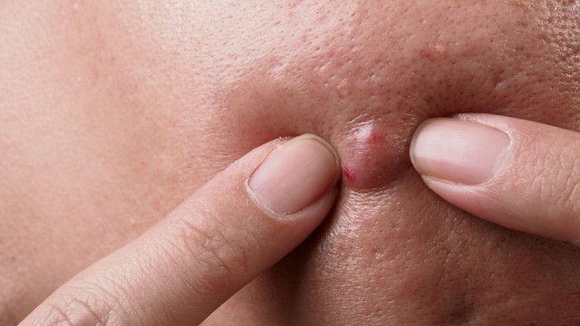 bai-viet/mun-boc-co-nen-nan-khong-cach-xu-ly-khi-bi-mun-boc.html