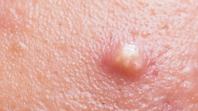 bai-viet/mun-boc-mu-nguyen-nhan-va-cach-dieu-tri-hieu-qua.html