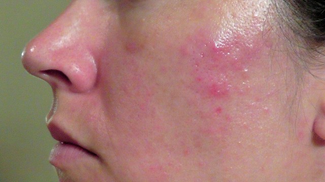 bai-viet/mun-boc-o-ma-nguyen-nhan-hinh-thanh-va-cach-dieu-tri-hieu-qua.html