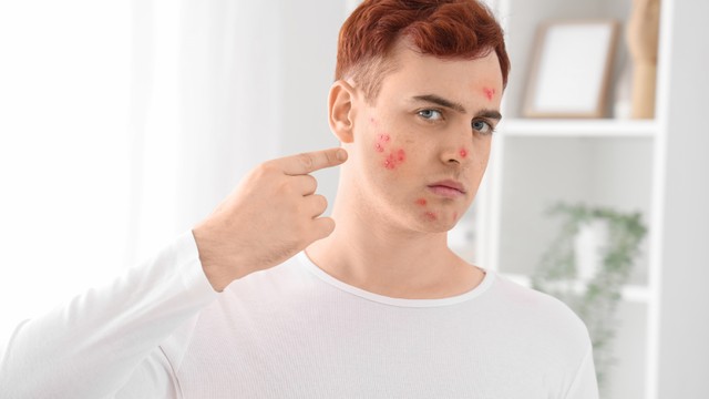 bai-viet/mun-boc-o-ma-va-nhung-thong-tin-ban-can-biet.html