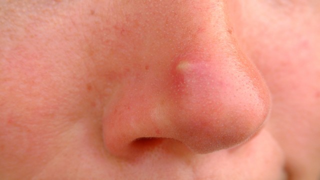 bai-viet/mun-boc-o-mui-la-gi-nguyen-nhan-dau-hieu-va-nhung-thong-tin-can-biet.html