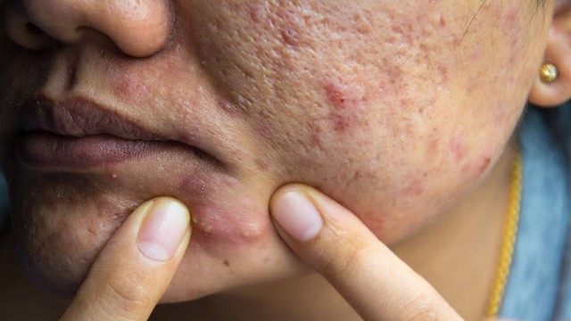 bai-viet/cach-xu-ly-mun-boc-sung-to-an-toan-han-che-tham-seo.html