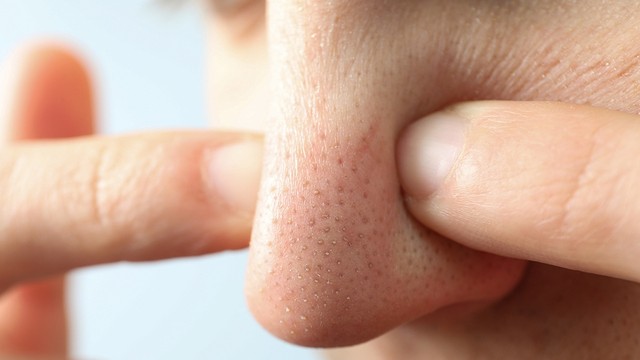 bai-viet/nguyen-nhan-cach-dieu-tri-va-phong-ngua-mun-cam-o-mui.html