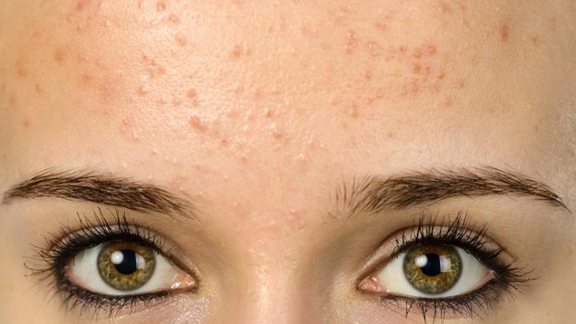 bai-viet/nguyen-nhan-gay-ra-mun-cam-o-tran.html