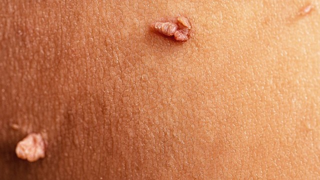 bai-viet/mun-coc-co-dau-khong-cac-bien-phap-phong-ngua-mun-coc-hieu-qua.html