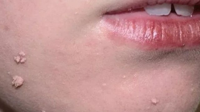 bai-viet/mun-coc-dang-soi-manh-la-gi-phuong-phap-dieu-tri-59641.html