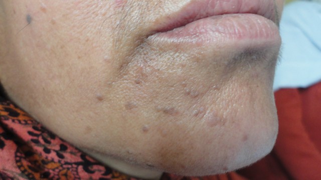 benh/mun-coc-phang.html