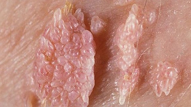 bai-viet/mun-coc-sinh-duc-va-sui-mao-ga-co-giong-nhau-khong-59156.html