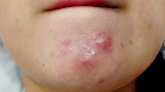 bai-viet/mun-cung-duoi-da-nguyen-nhan-va-cac-phuong-phap-dieu-tri-71413.html