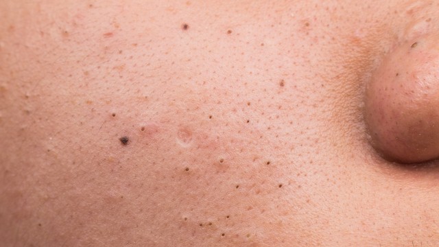 bai-viet/mun-dau-den-o-ma-nguyen-nhan-va-cach-tri-mun.html