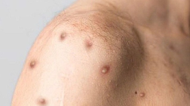 bai-viet/mun-hiv-la-gi-hieu-dung-trieu-chung-va-phong-tranh-lo-lang-khong-can-thiet.html