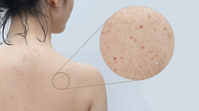 bai-viet/mun-lung-co-tu-het-khong-cach-dieu-tri-va-phong-ngua.html