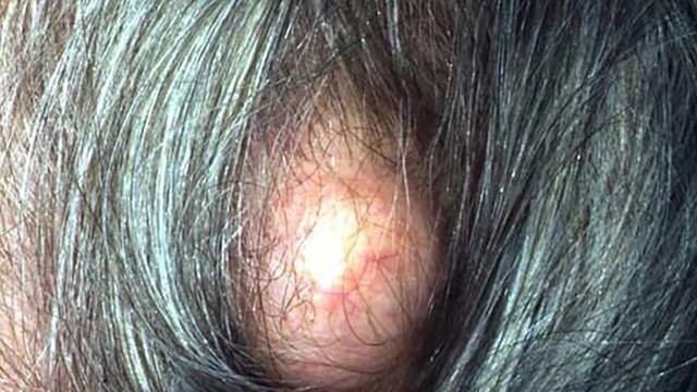 bai-viet/mun-nhot-o-dau-nguyen-nhan-trieu-chung-cach-dieu-tri.html