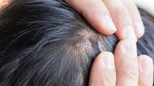 bai-viet/mun-nhot-tren-dau-do-dau-cach-dieu-tri-va-phong-ngua.html