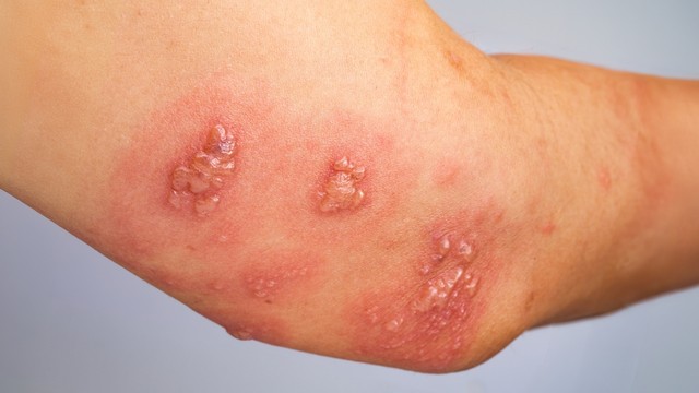 bai-viet/mun-nuoc-zona-bi-vo-nguy-co-cach-xu-ly-va-phong-ngua-hieu-qua.html