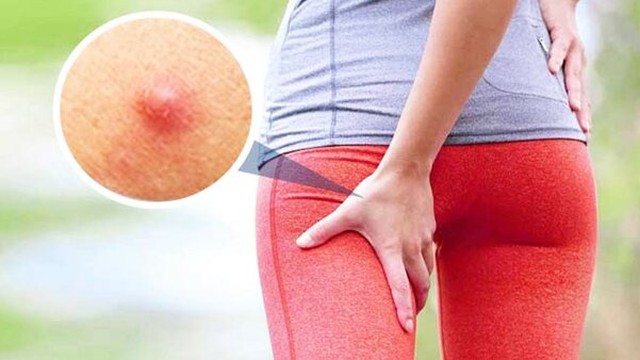 bai-viet/mun-o-mong-xuat-hien-la-do-dau-cach-de-xu-ly-mun-o-mong-tai-nha.html