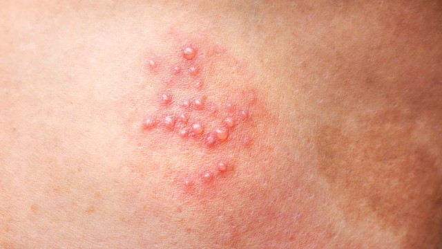 bai-viet/mun-rop-sinh-duc-nam-nguyen-nhan-va-cach-phong-ngua.html