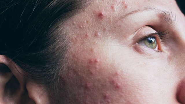 bai-viet/mun-san-la-gi-nguyen-nhan-gay-mun-va-cach-chua-mun-san-hieu-qua.html