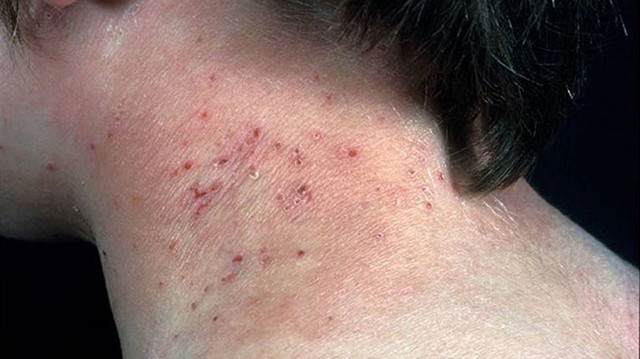 bai-viet/mun-sau-gay-nguyen-nhan-va-cach-khac-phuc-an-toan-hieu-qua.html