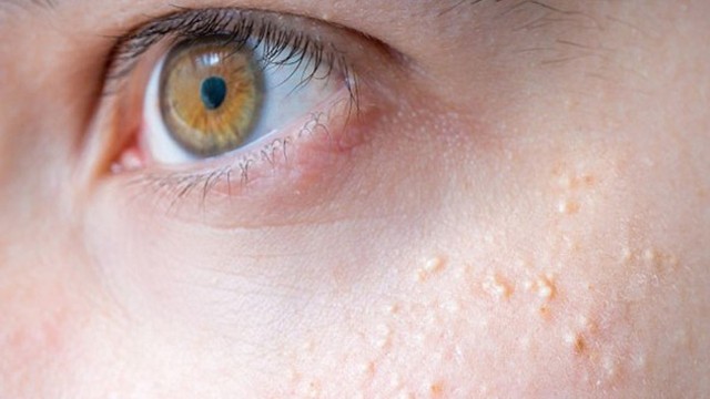 bai-viet/mun-thit-o-tre-em-nguyen-nhan-dau-hieu-va-phuong-phap-dieu-tri.html