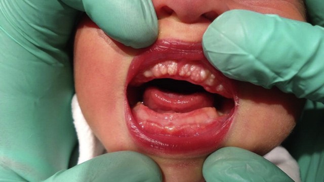 bai-viet/mun-trang-o-loi-tre-so-sinh-nguyen-nhan-va-phuong-phap-dieu-tri.html