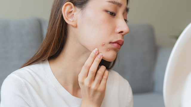 bai-viet/mun-trung-ca-trong-ky-kinh-nguyet-va-3-giai-doan-hinh-thanh-mun.html