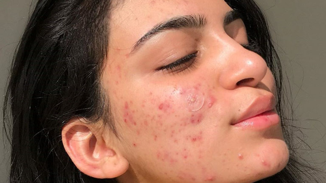 bai-viet/mun-tuoi-day-thi-keo-dai-bao-lau-nhung-dieu-ban-can-biet-ve-mun-tuoi-day-thi-67460.html