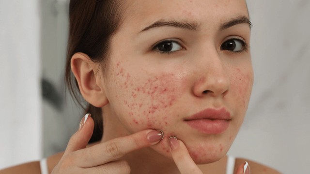 bai-viet/nguyen-nhan-va-cach-dieu-tri-tinh-trang-mun-viem-do-o-ma.html